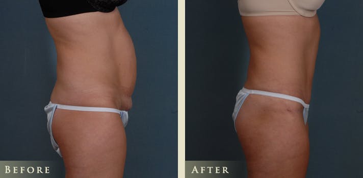 Tummy Tuck Before & After Gallery - Patient 363444 - Image 3