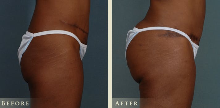 Brazilian Butt Lift Before & After Gallery - Patient 334375 - Image 2