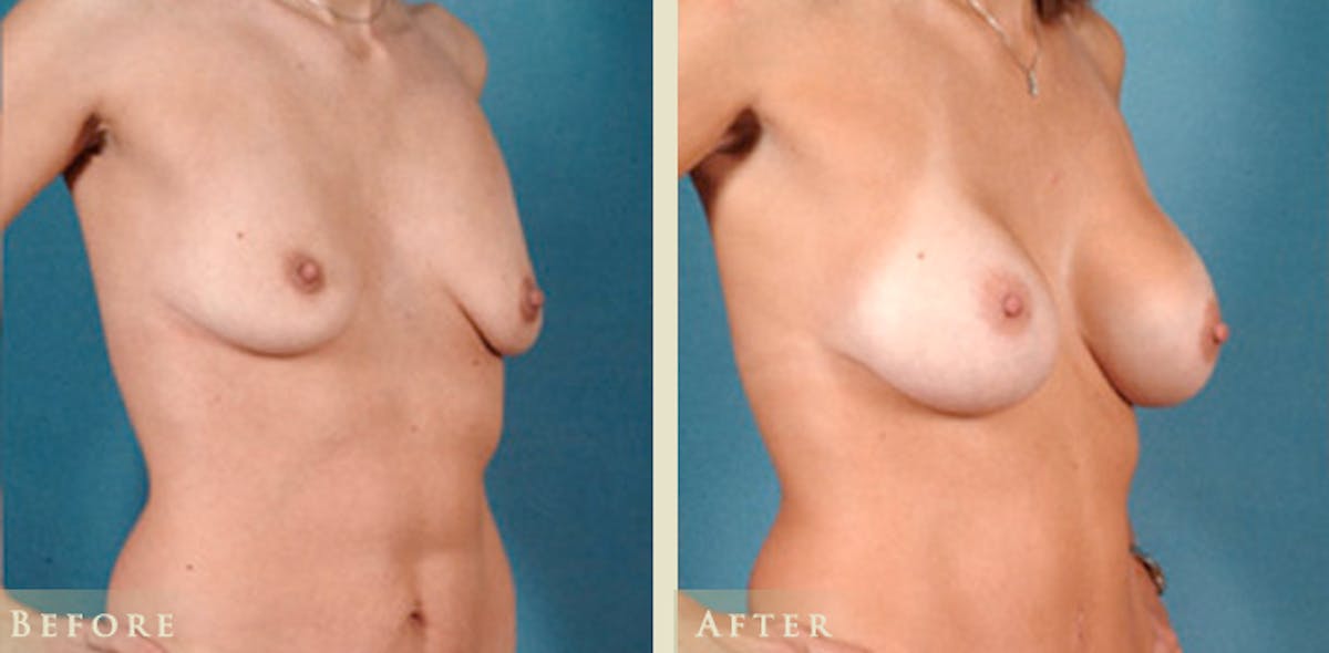 Breast Augmentation with Silicone Implants Before & After Gallery - Patient 139731 - Image 2
