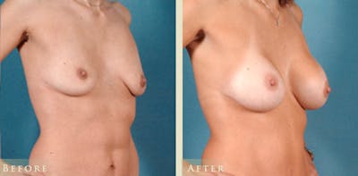 Breast Augmentation Before & After Gallery - Patient 139731 - Image 2