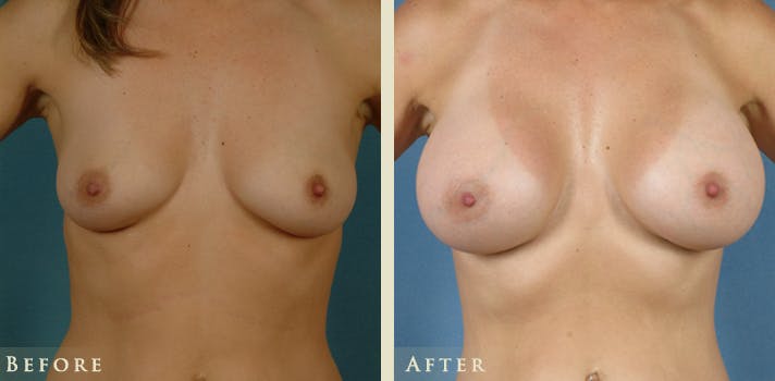 Breast Augmentation Before & After Gallery - Patient 148816 - Image 1