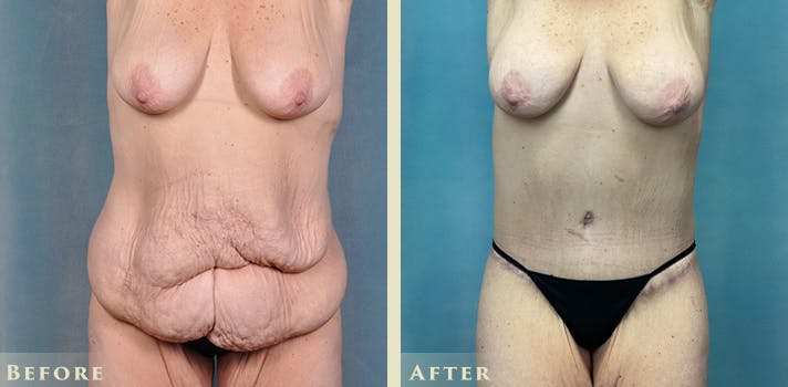 Female Liposuction Before & After Gallery - Patient 310401 - Image 1