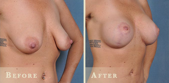 Breast Augmentation and Lift  Before & After Gallery - Patient 116105 - Image 2