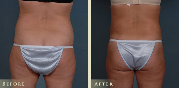 Tummy Tuck Before & After Gallery - Patient 363444 - Image 4