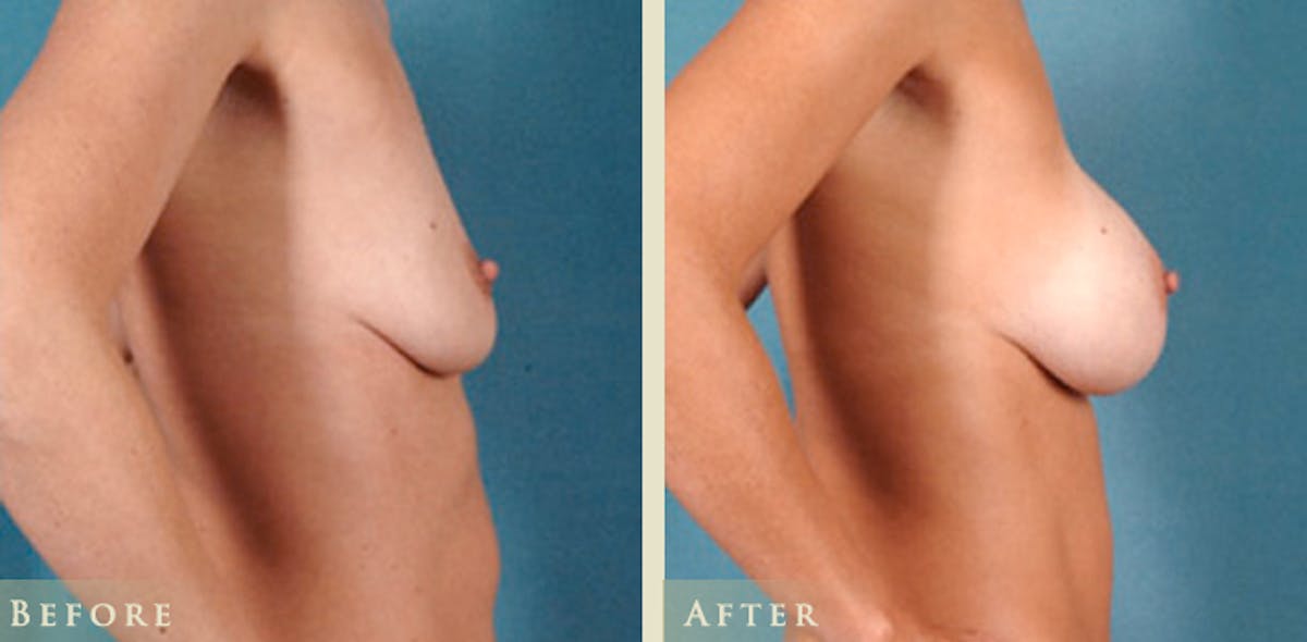 Breast Augmentation with Silicone Implants Before & After Gallery - Patient 139731 - Image 3