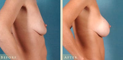 Breast Augmentation Before & After Gallery - Patient 139731 - Image 3