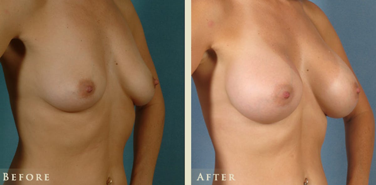 Breast Augmentation with Saline Implants Before & After Gallery - Patient 220824 - Image 2