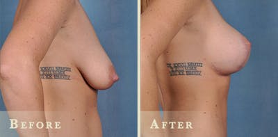 Breast Augmentation and Lift Before & After Gallery - Patient 116105 - Image 3