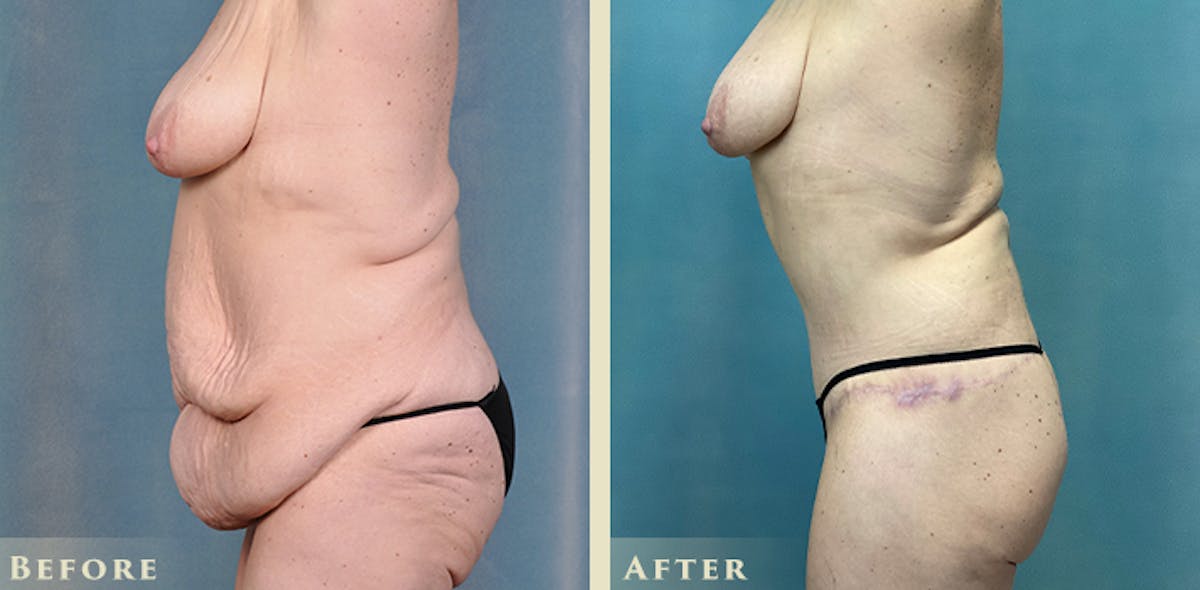Female Liposuction Before & After Gallery - Patient 310401 - Image 3