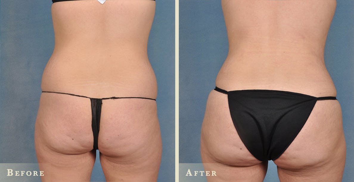 Brazilian Butt Lift Before & After Gallery - Patient 246008 - Image 2