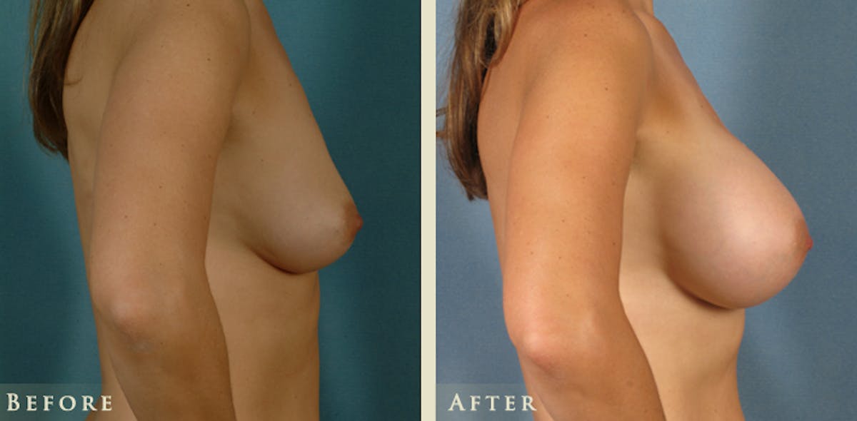 Breast Augmentation with Saline Implants Before & After Gallery - Patient 220824 - Image 3