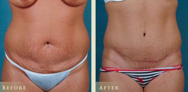 Tummy Tuck Before & After Gallery - Patient 151127 - Image 1