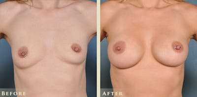 Breast Augmentation Before & After Gallery - Patient 403841 - Image 1