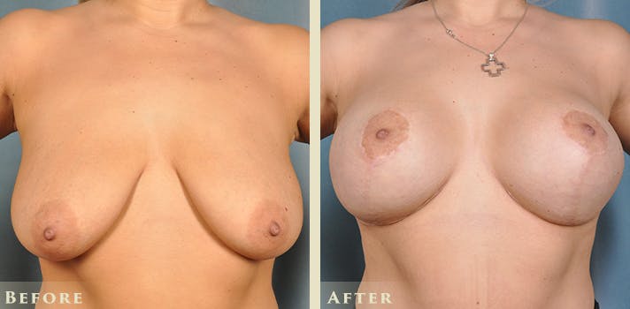 Breast Augmentation and Lift Before & After Gallery - Patient 921224 - Image 1