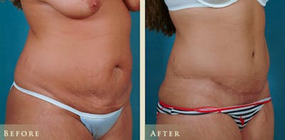 Tummy Tuck Before & After Gallery - Patient 151127 - Image 2