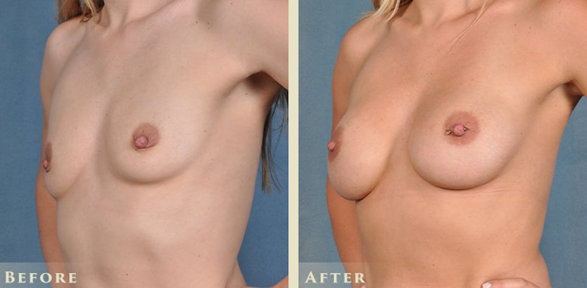 Breast Augmentation with Silicone Implants Before & After Gallery - Patient 403841 - Image 2