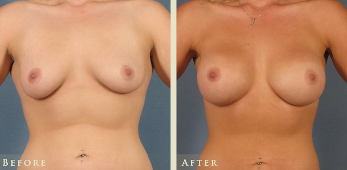 Breast Augmentation with Saline Implants Before & After Gallery - Patient 234427 - Image 1