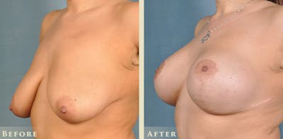 Breast Augmentation and Lift Before & After Gallery - Patient 921224 - Image 2