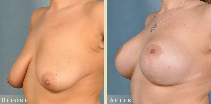 Breast Augmentation and Lift Before & After Gallery - Patient 921224 - Image 2