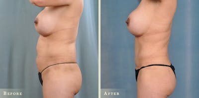 Brazilian Butt Lift Before & After Gallery - Patient 136453 - Image 1