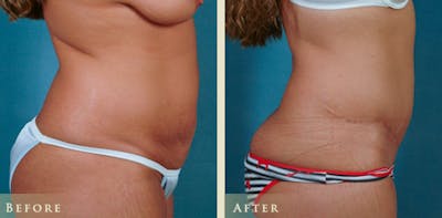 Tummy Tuck Before & After Gallery - Patient 151127 - Image 3