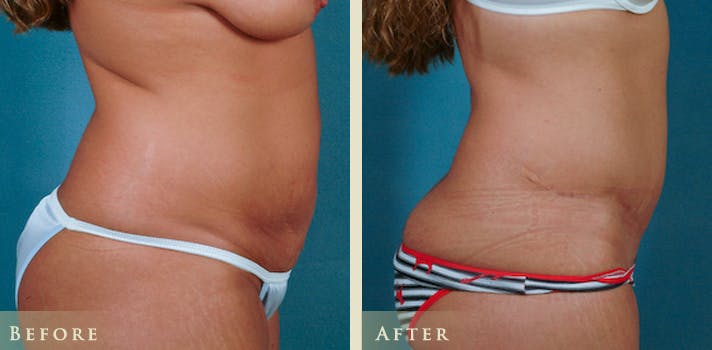 Tummy Tuck Before & After Gallery - Patient 151127 - Image 3