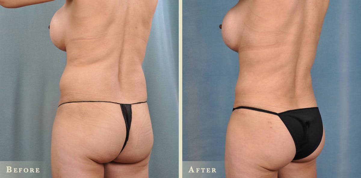 Brazilian Butt Lift Before & After Gallery - Patient 136453 - Image 2
