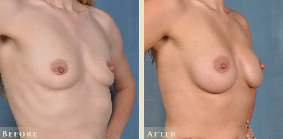 Breast Augmentation with Silicone Implants Before & After Gallery - Patient 403841 - Image 3
