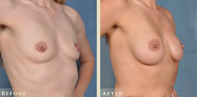 Breast Augmentation Before & After Gallery - Patient 403841 - Image 3