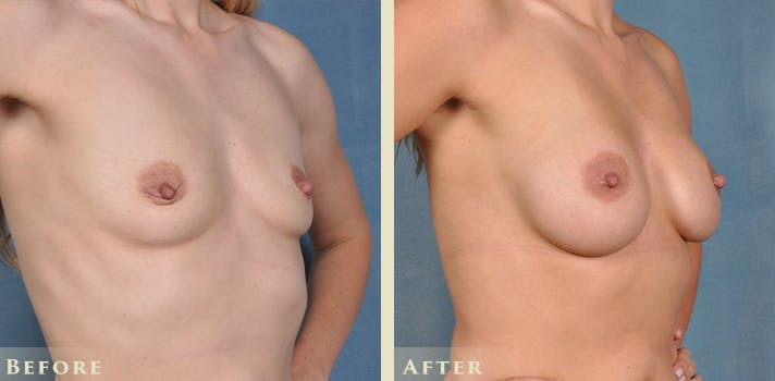 Breast Augmentation Before & After Gallery - Patient 403841 - Image 3