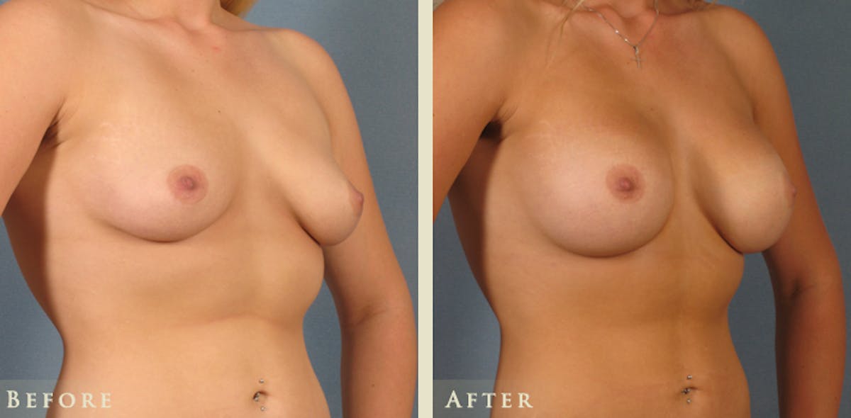 Breast Augmentation with Saline Implants Before & After Gallery - Patient 234427 - Image 2
