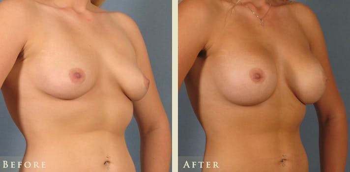 Breast Augmentation Before & After Gallery - Patient 290650 - Image 2