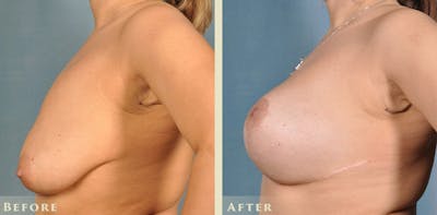Breast Augmentation and Lift Before & After Gallery - Patient 921224 - Image 3