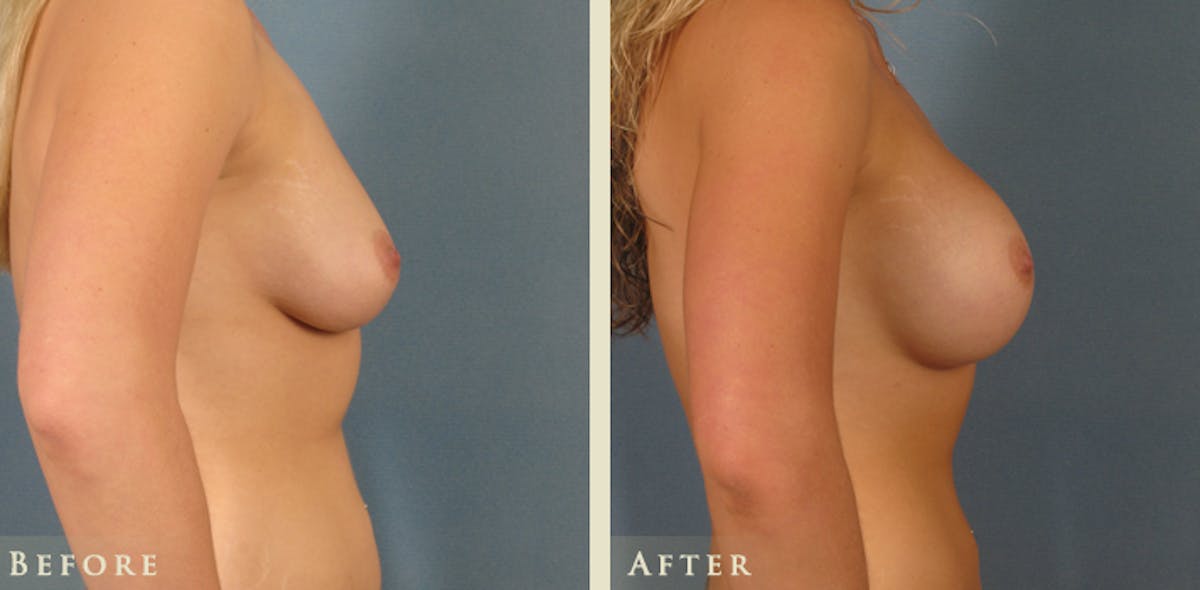 Breast Augmentation with Saline Implants Before & After Gallery - Patient 234427 - Image 3