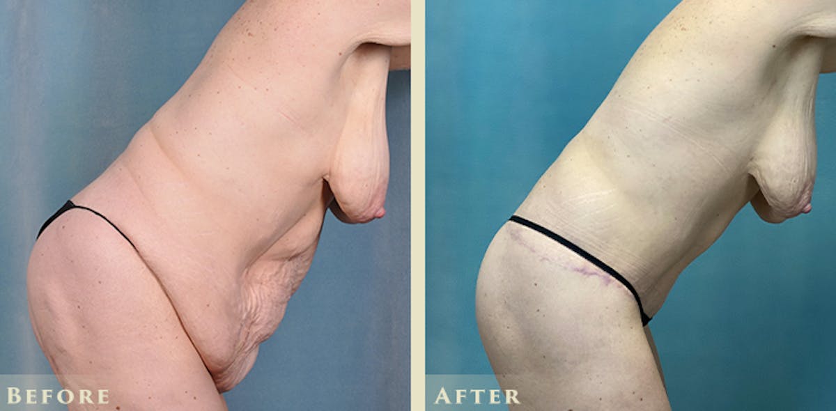 Female Liposuction Before & After Gallery - Patient 310401 - Image 6