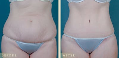 Tummy Tuck Before & After Gallery - Patient 373403 - Image 1