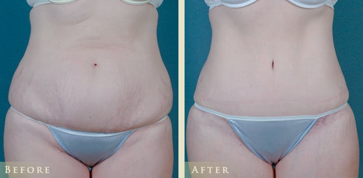 Tummy Tuck Before & After Gallery - Patient 373403 - Image 1