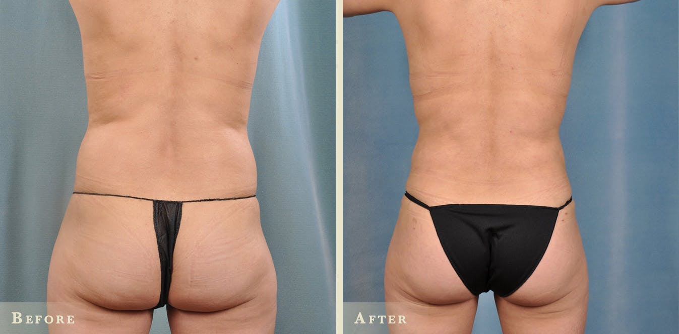 Brazilian Butt Lift Before & After Gallery - Patient 136453 - Image 3