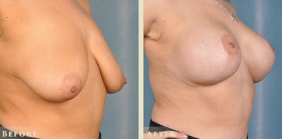 Breast Augmentation and Lift Before & After Gallery - Patient 921224 - Image 4