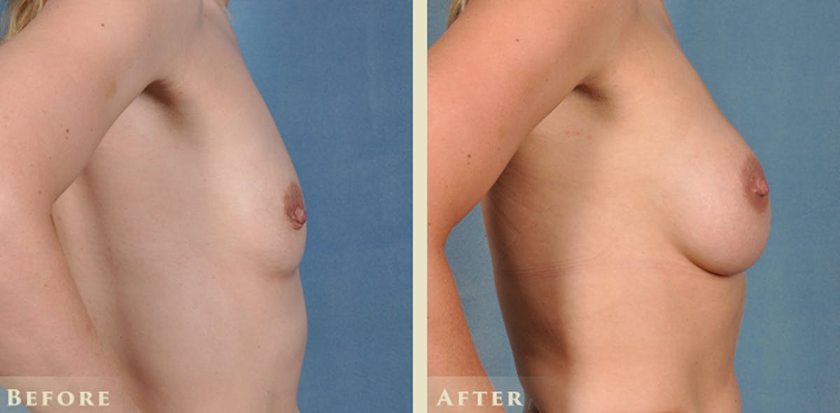 Breast Augmentation with Silicone Implants Before & After Gallery - Patient 403841 - Image 4