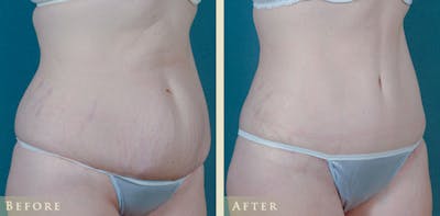 Tummy Tuck Before & After Gallery - Patient 373403 - Image 2