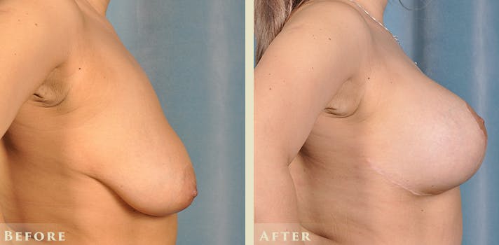 Breast Augmentation and Lift Before & After Gallery - Patient 921224 - Image 5