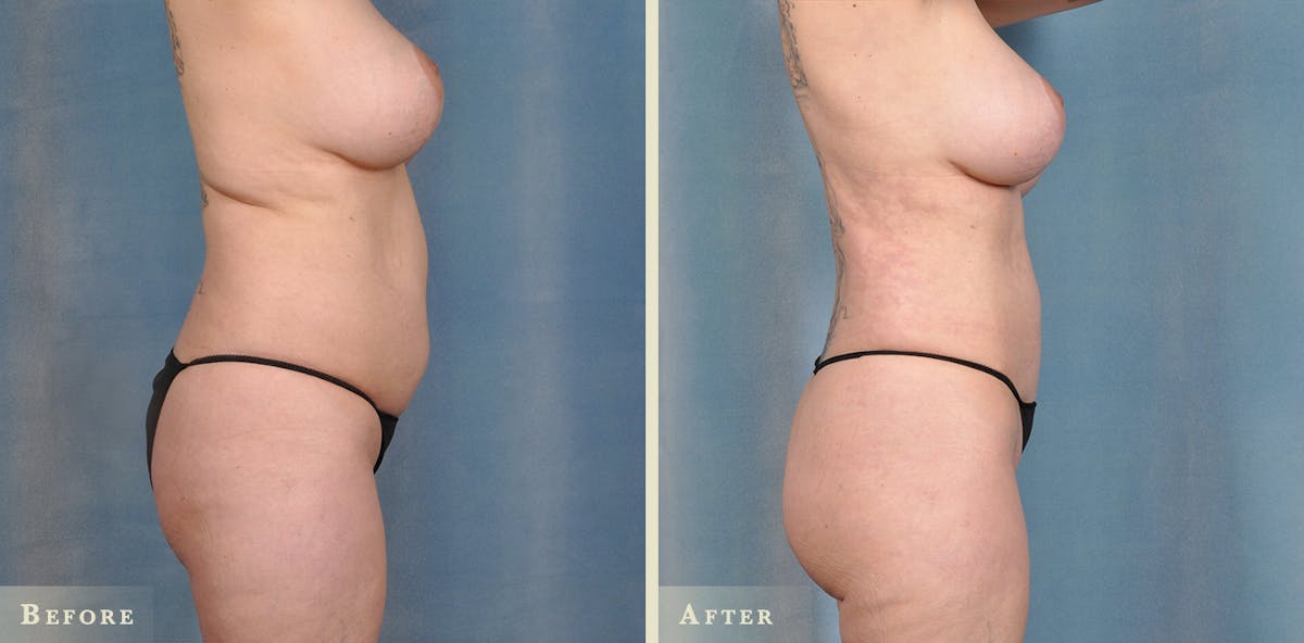 Brazilian Butt Lift Before & After Gallery - Patient 288374 - Image 1