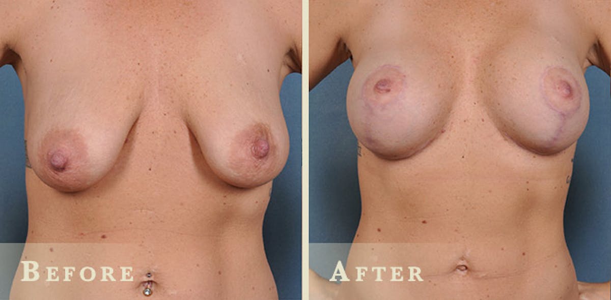 Breast Augmentation with Saline Implants Before & After Gallery - Patient 354149 - Image 1