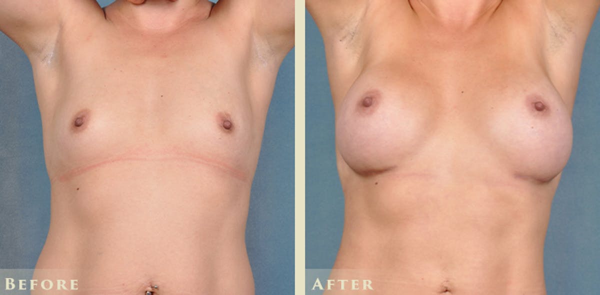 Breast Augmentation with Silicone Implants Before & After Gallery - Patient 420704 - Image 1