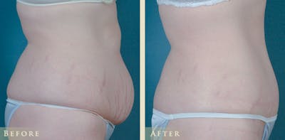 Tummy Tuck Before & After Gallery - Patient 373403 - Image 3