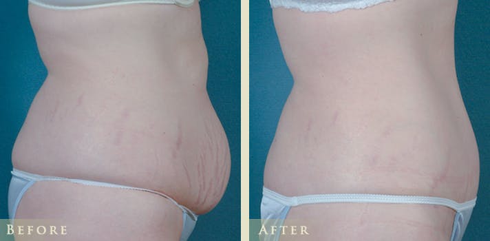 Tummy Tuck Before & After Gallery - Patient 373403 - Image 3