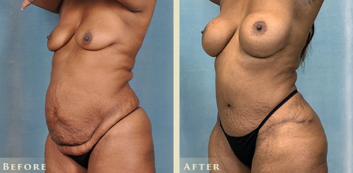 Female Liposuction Before & After Gallery - Patient 104661 - Image 2