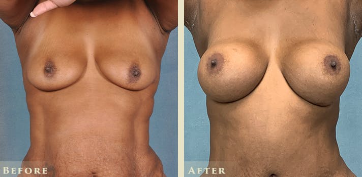Breast Augmentation and Lift  Before & After Gallery - Patient 302480 - Image 1