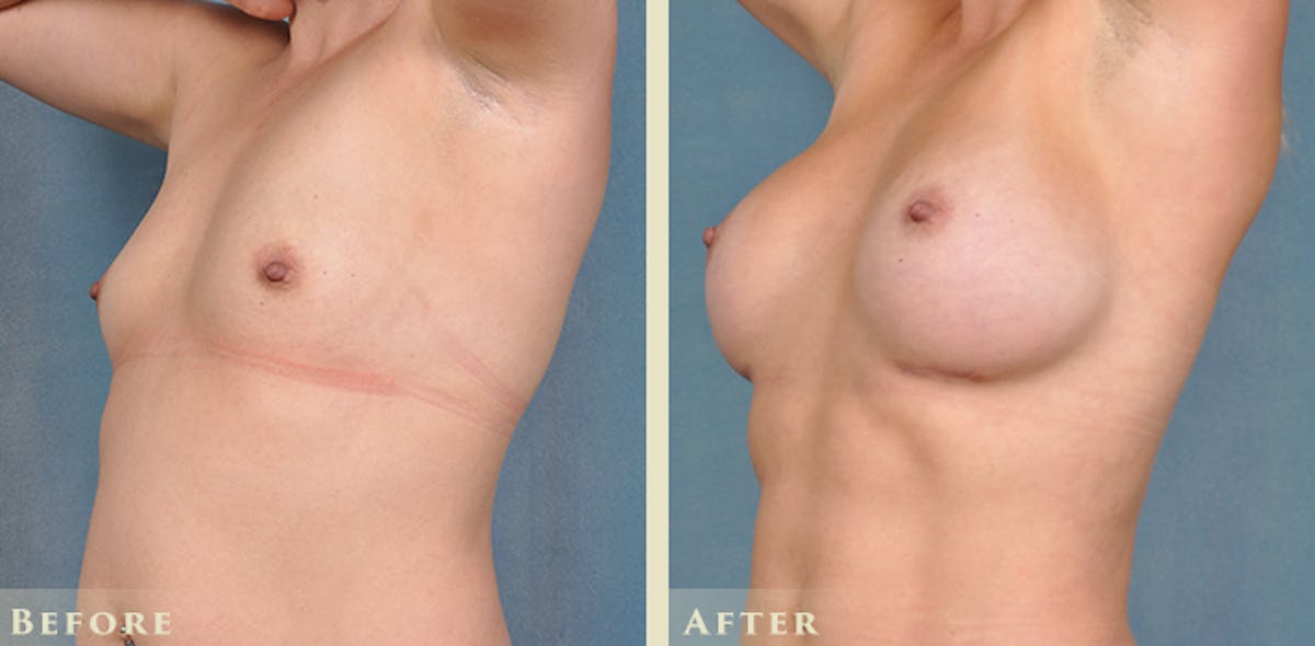 Breast Augmentation with Silicone Implants Before & After Gallery - Patient 420704 - Image 2